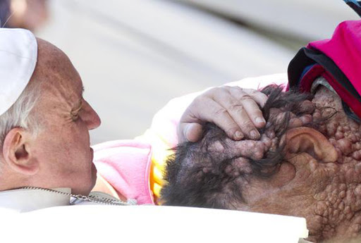 Homme défiguré bénit par le pape &#8211; pt