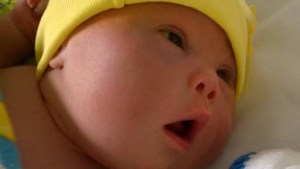 Bebê com Síndrome de Down