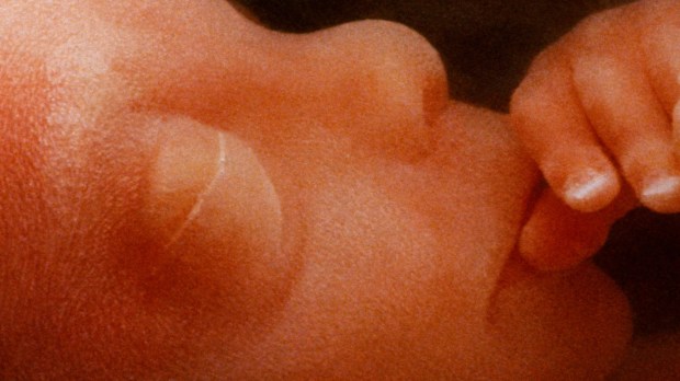 Bebê em gestação em risco de aborto